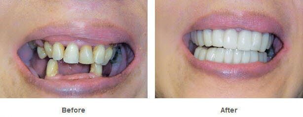 snap-teeth.jpg snap-teeth.jpg